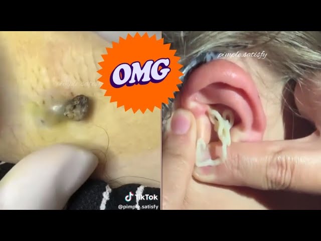 Blackhead Popping Extravaganza: Satisfying Skin Care Moments